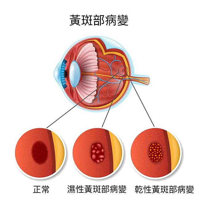 欧亿3账号注册 什么是黄斑部病变